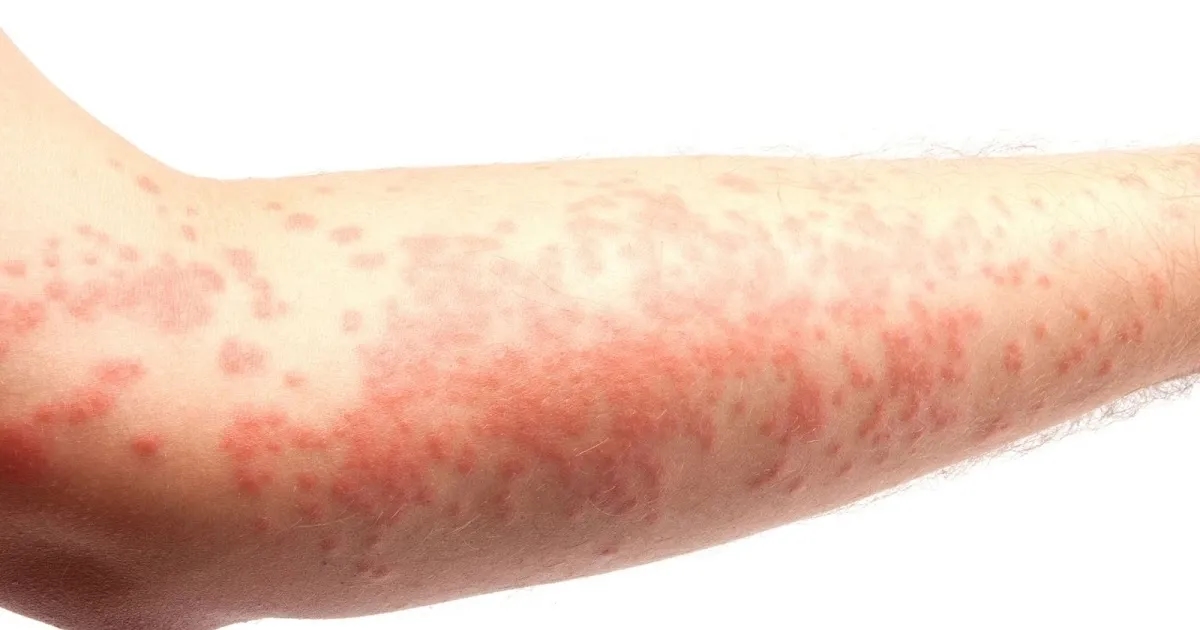 Alergia na sierść: objawy skórne, które mogą zaskoczyć każdego